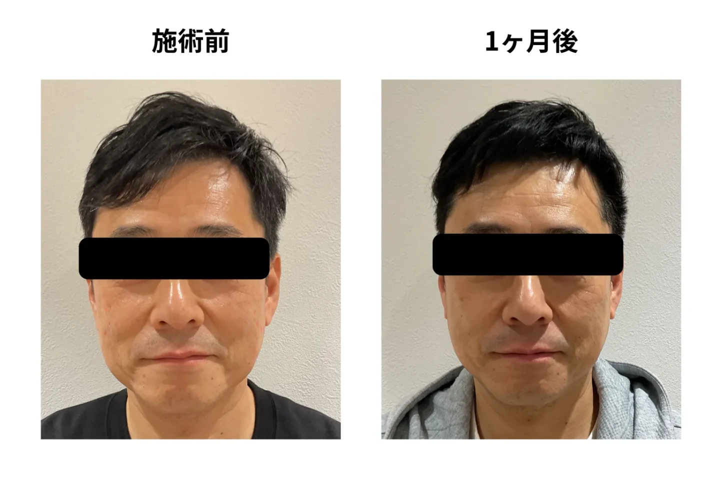 ハイフの症例写真。施術前、1か月後の写真。