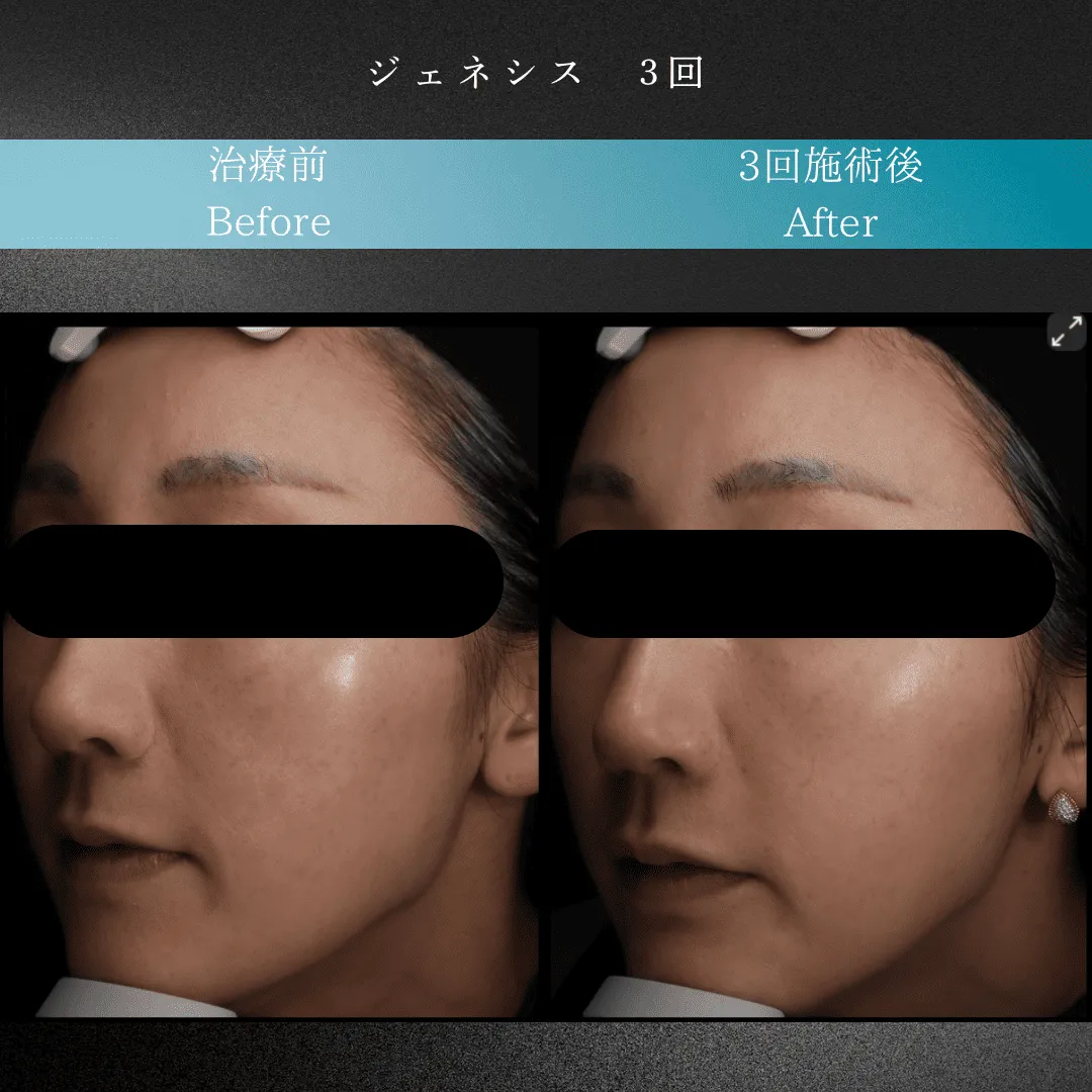 ジェネシスの症例写真。施術前、3回施術後の写真。