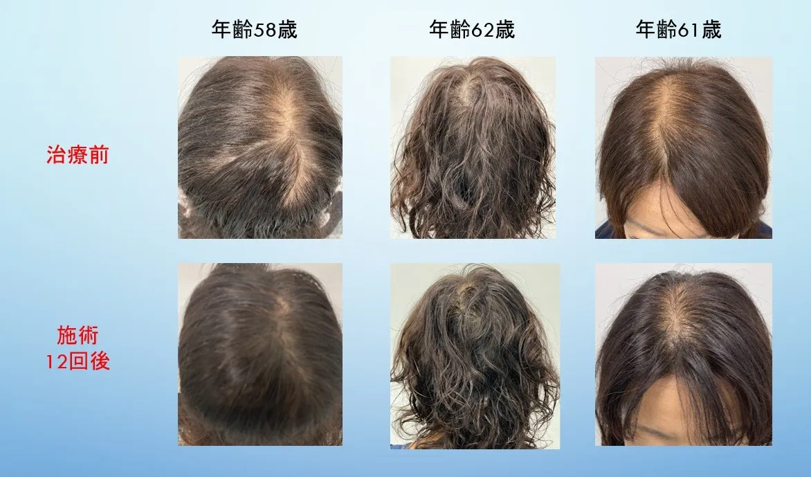 メソナJ施術の症例イメージ（治療前、施術12回後）